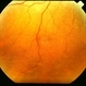Central Serous Chorioretinopathy 6